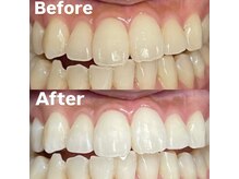 ホワイトニングビューティー 光の森店(WHITENING BEAUTY)/ホワイトニング♪