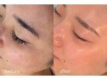 サロンムーン 赤坂(salon moon)/シミのない輝く若々しい肌目指す