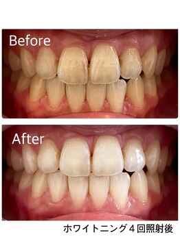 クリア(Clear)の写真/高い実績を誇る最先端マシンを使用☆セルフホワイトニングで驚きと感動のビフォーアフター体験…！?