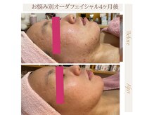 ポムポムボナーの雰囲気（ニキビケアで、かゆみと繰り返すトラブル予防◎毛穴汚れも解消）