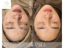 ベルフィーヌ 目黒店(BELFINE)/ハーブピーリング