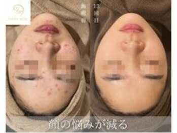 ベルフィーヌ 目黒店(BELFINE)/ハーブピーリング