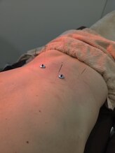 ムラサキ鍼灸治療院(MURASAKI鍼灸治療院)/身体の悩みそのままにしない！