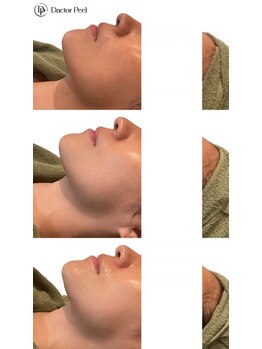 リムビューティー 自由が丘(RymBeauty)の写真/ついに解禁★ララピール特許保持者が最上級のピーリングDactorPELLを施術開始！エイジングケアにも◎