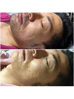 トータルメンズエステ キング(KING)/美容電気脱毛