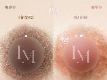 クローバー 松戸(clover)/【ルメラ】乳輪　黒ずみケア