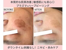 イリゼ(iriser)の雰囲気（プラズマ×ハーブでW効果！肌深部にハーブが届きシミやニキビ◎）