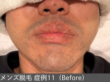 オアシスラグーン(OASIS LAGOON)/メンズ脱毛（症例11 before）