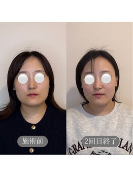 リスタット 市原(Restat)の写真/鏡を見るたびが、楽しみになる。フェイスラインすっきり小顔矯正☆
