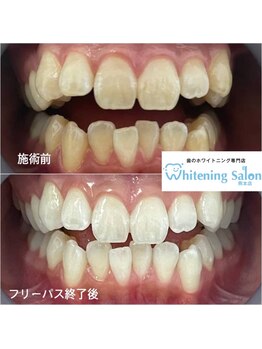 ホワイトニングサロン 熊本店/セルフホワイトニング