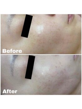 ブランシェ 高岡店 × 椿/シミケア　お客様