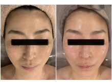 ブリノス(BLINOSS)/シミケアフェイシャル