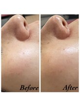 エクラルム(Eclaleum)/BeforeAfter ラブレションコース