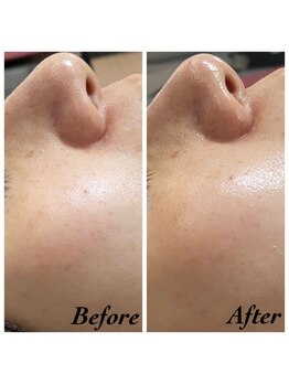 エクラルム(Eclaleum)/BeforeAfter ラブレションコース