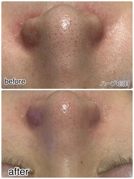 エンチャント(ENCHANT)/ハーブピーリングで肌質改善