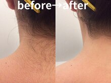 ももとゆでたまご/襟足シェービングbefore→after