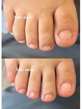 むしっていた爪が３ヶ月で