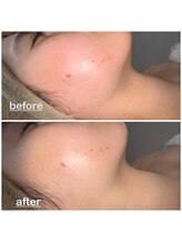 ミニョン(mignon)/ニキビ