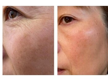 ケンビラク(Kenbiraku 健美楽)/ハイドラ　プラズマ　RF　美容液