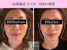 キュープ 福岡九大学研都市店(Qpu)/小顔矯正４回コースの変化