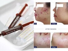 韓国で大人気！水光ピーリング！古い角質を取り毛穴を引き締める