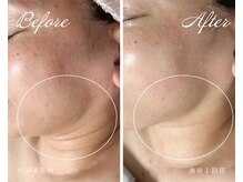 ラシック(LACHIC)の雰囲気（【半永久的小顔】キュッと引き締まったフェイスラインに★）