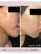 ラブ美長寿 沖縄本店(Lab)/ビフォーアフター光フェイシャル