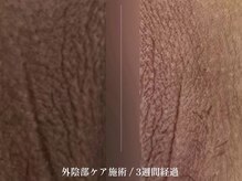 クローバー 松戸(clover)/【ルメラ】外陰部　黒ずみケア