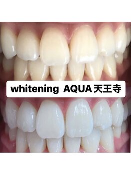 アクア 天王寺店(AQUA)/セルフホワイトニング効果