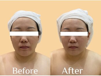 オプレア 千種店(OPREA)/コルギ◆浮腫みレス！