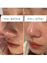 ミタス(Me+)/毛穴洗浄BeforeAfter