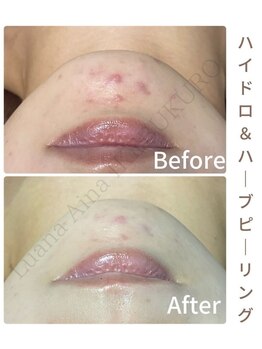 ルアナアイナ 池袋店(Luana Aina)/古い角質を優しく取り除きます。