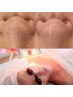 【毛穴×黒ずみ】《毛穴クリアフェイシャル》顔脱毛付♪　