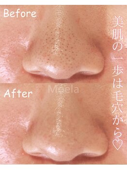 モエラビューティーサロン(Moela beauty salon)/【全顔毛穴洗浄】