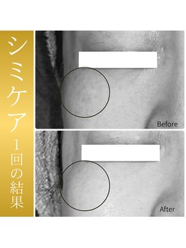 テセラ(Tethere)/シミケア1回の結果