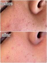 ユフラ(Juhla)/韓国式ハーブピーリング