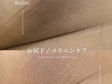 クローバー 松戸(clover)/【ルメラ】お尻下　黒ずみケア