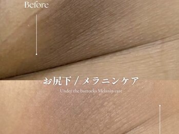 クローバー 松戸(clover)/【ルメラ】お尻下　黒ずみケア