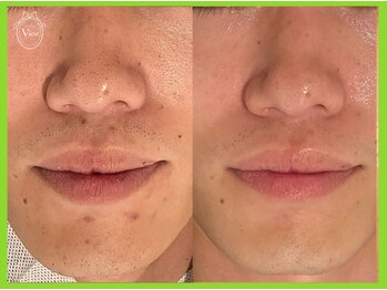 ヴィオール 名古屋栄店(VIOR)/男性にも人気なハーブピーリング