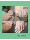 トラブル爪 before after