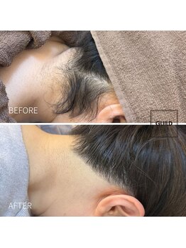 ギルドハナレ(GUILD HANARE)/"うなじ脱毛"