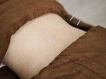 明るき鍼灸院・接骨院/鍼灸/自律神経不調もケア！