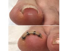 巻き爪・爪トラブルもお任せください！