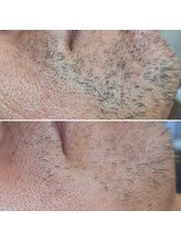 ミラージュ(mirage)/髭ダブル脱毛