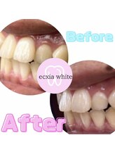 エクシアホワイト 浦安店/ホワイトニングビフォーアフター