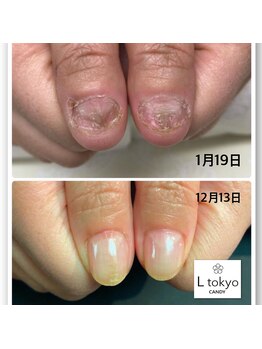 エル トウキョウ キャンディ(L tokyo CANDY)/深爪矯正役1年後