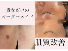 オーダーメイドで叶える肌質改善/シミケア/ハーブピーリング