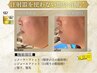 【脂肪分解レモンボトル】レモンボトル注入 1cc 脱二重アゴで小顔に！