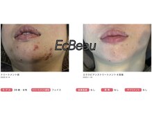 エクボ(EcBeau)/水光ピーリング