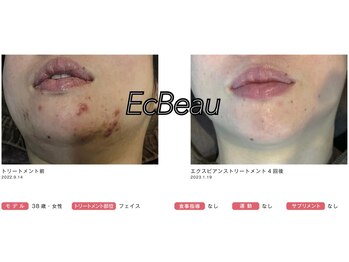 エクボ(EcBeau)/水光ピーリング